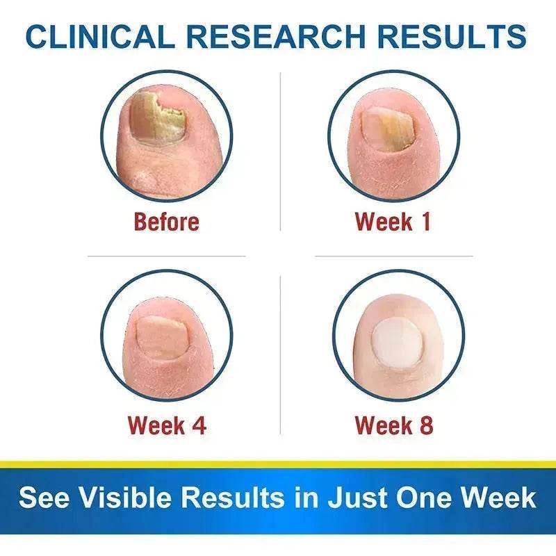 7DAYS Nail Fungus Treatment Serum Care Hand And Foot Care Removal - www.Shopthatapp.com