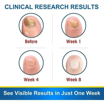 7DAYS Nail Fungus Treatment Serum Care Hand And Foot Care Removal - www.Shopthatapp.com