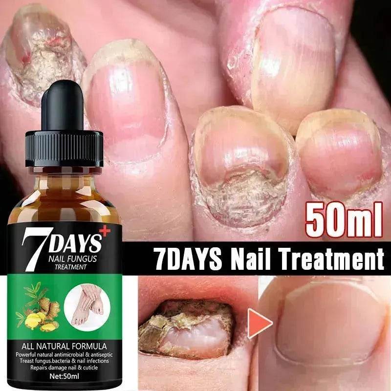7DAYS Nail Fungus Treatment Serum Care Hand And Foot Care Removal - www.Shopthatapp.com