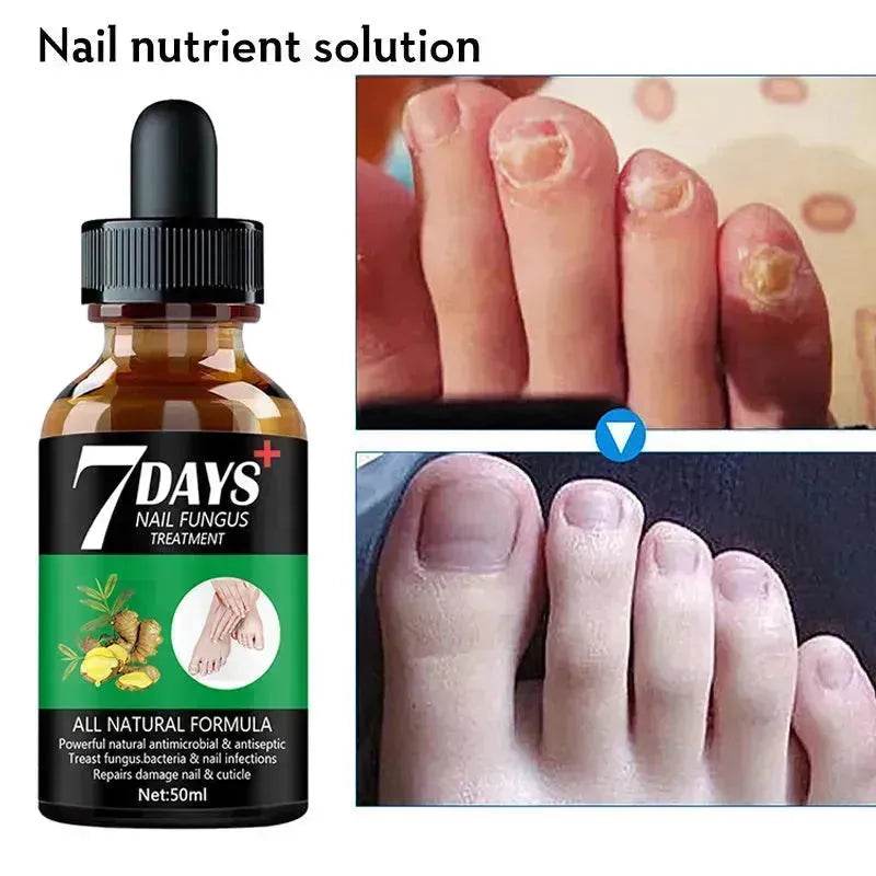 7DAYS Nail Fungus Treatment Serum Care Hand And Foot Care Removal - www.Shopthatapp.com