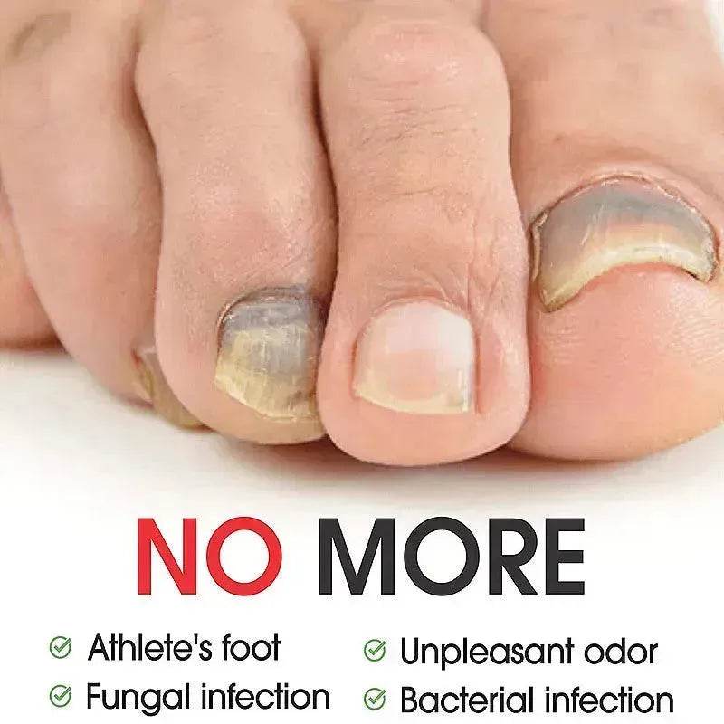 7DAYS Nail Fungus Treatment Serum Care Hand And Foot Care Removal - www.Shopthatapp.com