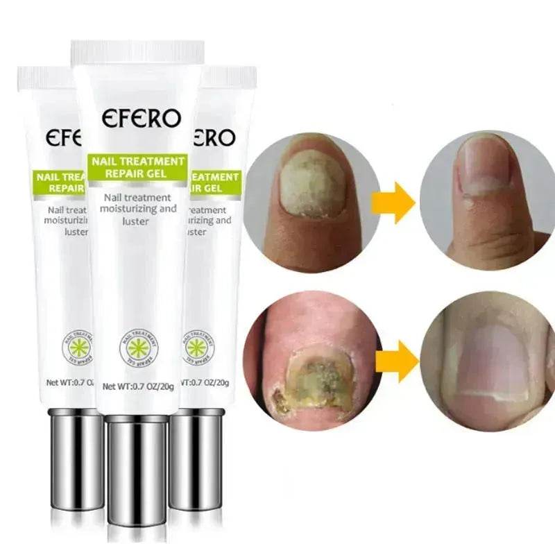 Nail Treatment Serum Nail Foot Nail Fungus Removal Gel Anti Infection Onychomycosis Nail Repair Cream Feet Care - www.Shopthatapp.com
