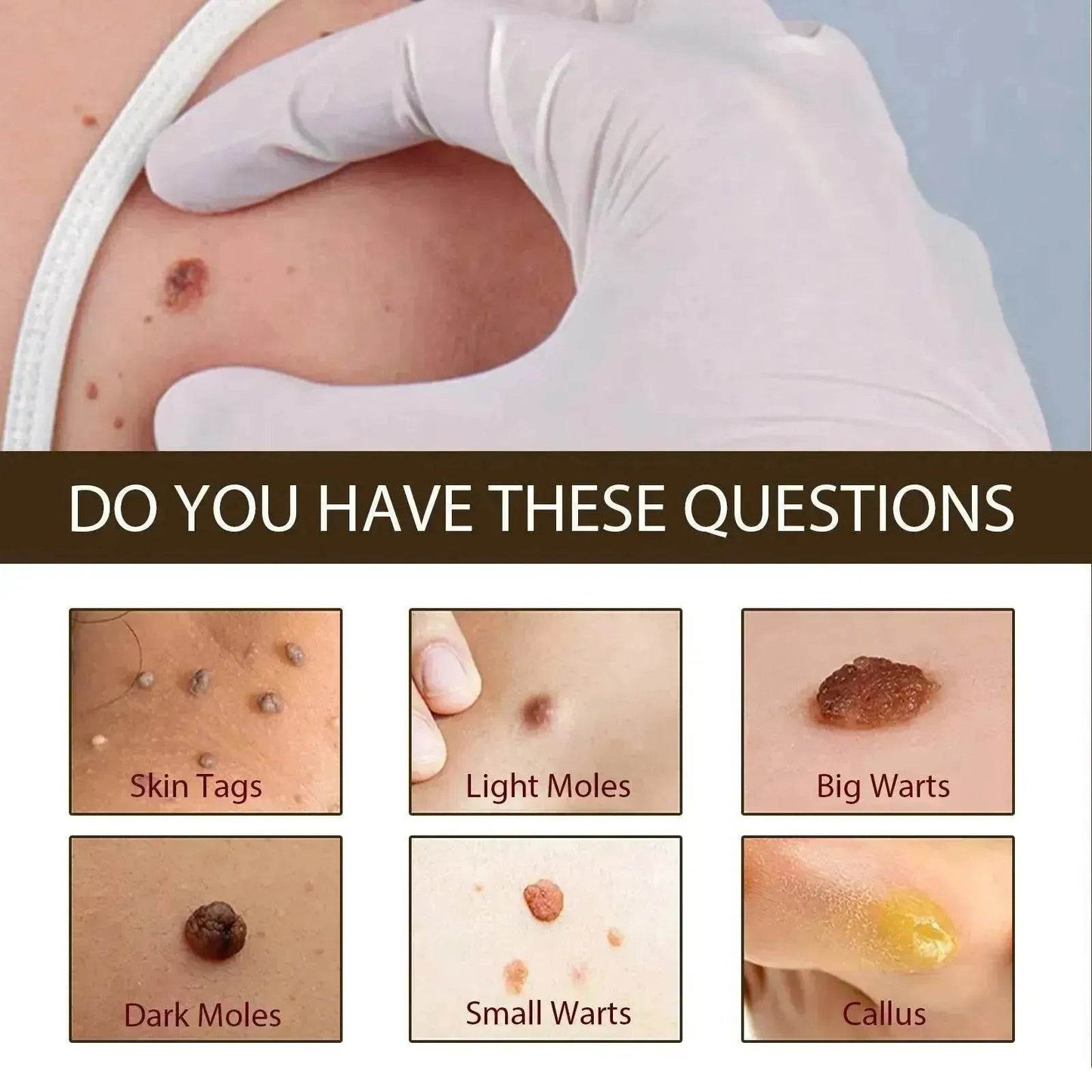 Wart Removal - Skin Cleansing Black Mole Wart Ointment Hand & Foot And Face - www.Shopthatapp.com