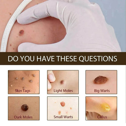 Wart Removal - Skin Cleansing Black Mole Wart Ointment Hand & Foot And Face - www.Shopthatapp.com