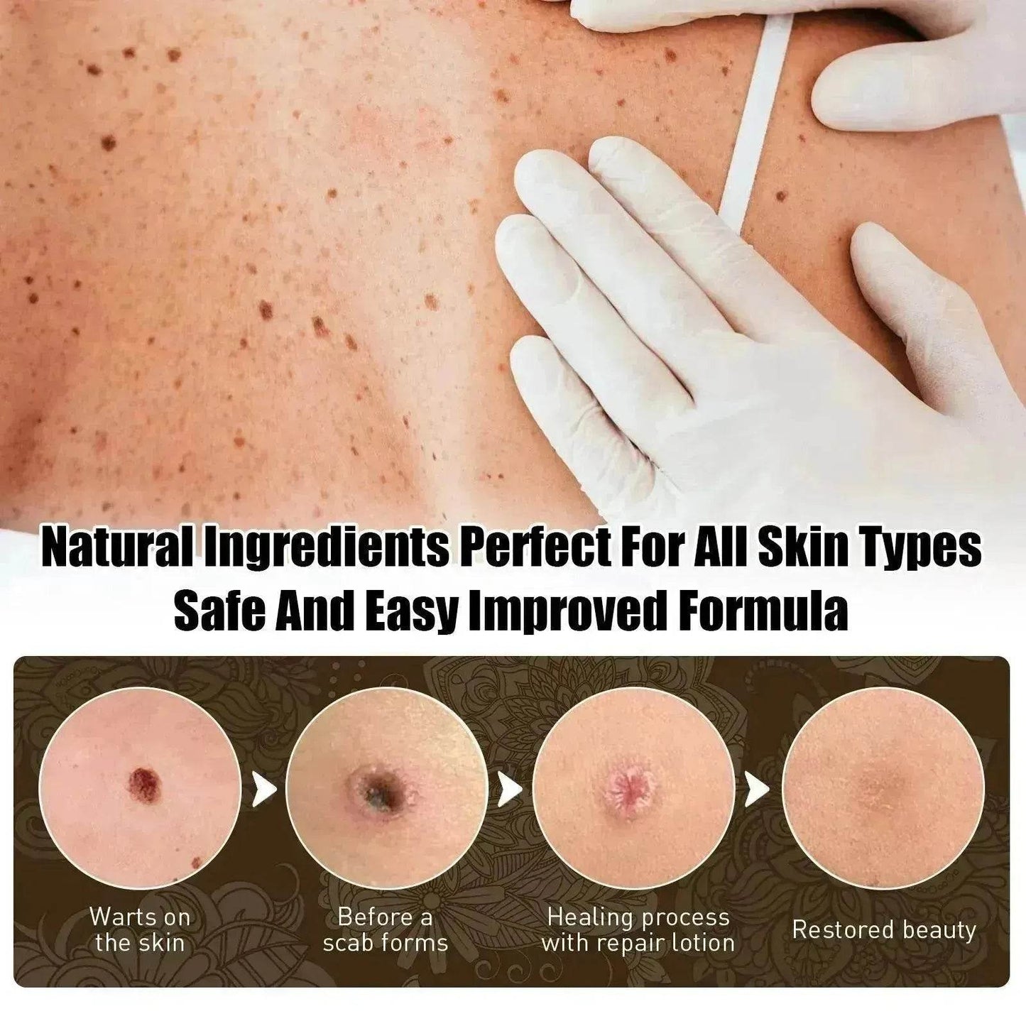 Wart Removal - Skin Cleansing Black Mole Wart Ointment Hand & Foot And Face - www.Shopthatapp.com